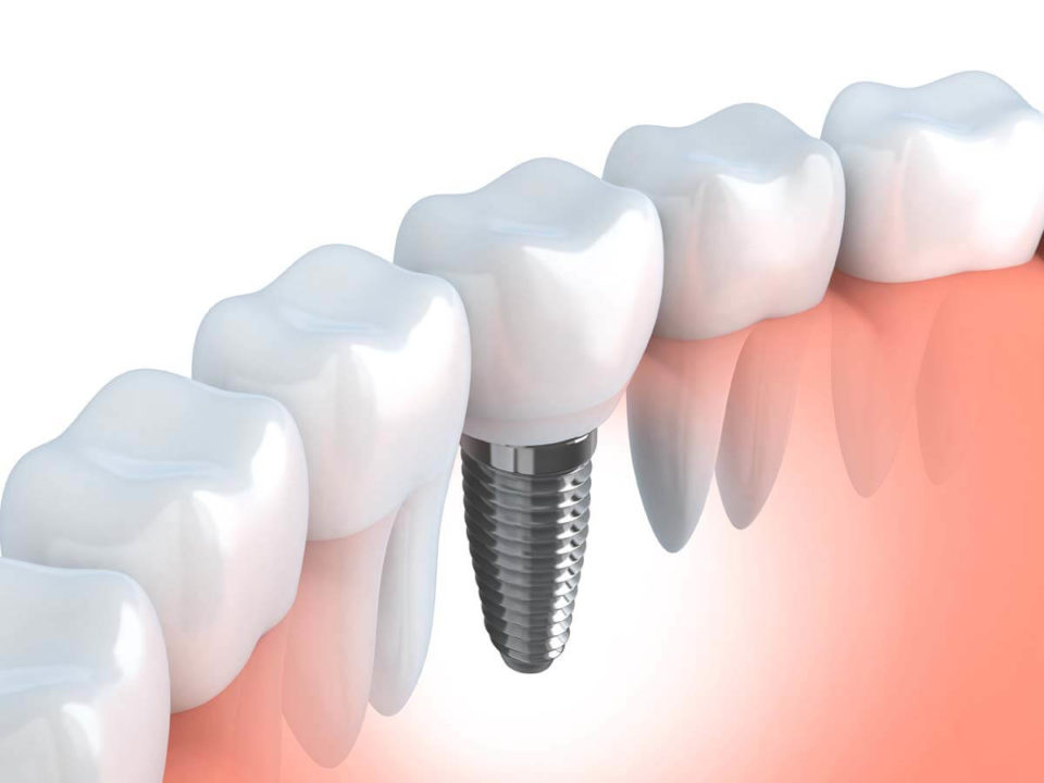 Implanty zębów ICX