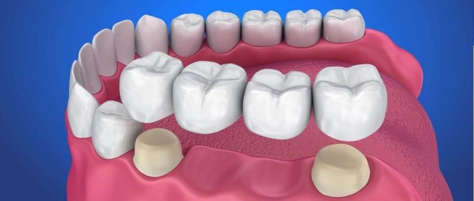 Mosty protetyczne – uzupełnienie brakujących zębów